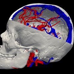 0.jpg 3D Model of Brain Arteriovenous Malformation