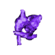 atrial_septal_defectpulmonary_truck_heart.stl 3D Model of Heart with Atrial Septal Defect
