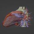 2.png 3D Model of Human Heart with Pulmonary Artery Sling (PAS) - generated from real patient