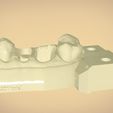 untitled.54.jpg Digital Dental Quadrant  Model with a Full Contour Crown
