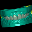 front.png STL file Dental Model With 10 Veneers and Articulator・Model to download and 3D print