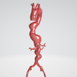 Thoracoabdominal-aortic-aneurysm.png Case 1 to 6: 3D aortic and iliac artery aneurysm