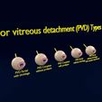 posterior-vitreous-detachment-types-eye-3d-model-blend-45.jpg Posterior vitreous detachment types eye 3D model