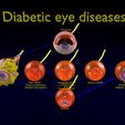 dm-1.jpg Diabetic eye diseases model