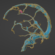 uv18.png 3D Model of Brain Arteriovenous Malformation