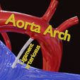 ps-0021.jpg PDA Patent Ductus Arteriosus vs Normal blood circulation