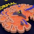 ps8.jpg Alzheimer Disease Brain coronal slice