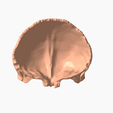 5.png FRONTAL BONE SEGMENTED 3D MODEL
