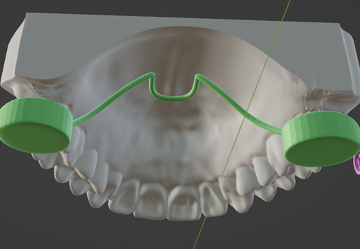 🦴 HIGH RESOLUTION MARA (Mandibular Anterior Repositioning Appliance ...