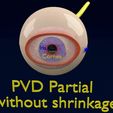 posterior-vitreous-detachment-types-eye-3d-model-blend-66.jpg Posterior vitreous detachment types eye 3D model