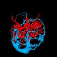 i13.jpg 3D Model of Brain Arteriovenous Malformation