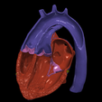 1.png 3D Model of Heart with Transposition of the Great Arteries, long axis view