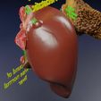 liver-cancer-hcc-vs-metastatic-3d-model-479eb1d978.jpg Liver cancer HCC vs Metastatic 3D model