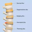 2.webp Spine defects