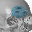 cranio-8.jpg A cranial plate to replace a skull defect (an example of a real operation 2)