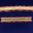 image-1.jpg 3D Asthma bronchiole obstruction model