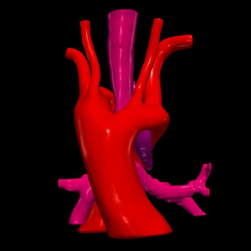 1.jpg 3D Model of Double Aortic Arch