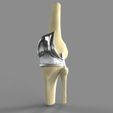 untitled.12.jpg Knee Replacement