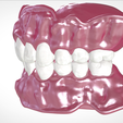 Screenshot_17.png Digital Full Dentures for Gluedin Teeth with Manual Reduction