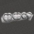 dientescult1.jpg Occlusal tooth cavities in lower teeth