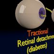 retinal-detachment-types-eye-3d-model-blend-93.jpg Retinal detachment types eye 3D model