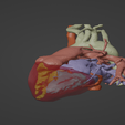 2.png 3D Model of Human Heart with Double Outlet Right Ventricle (DORV) - generated from real patient