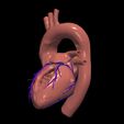 7.jpg 3D Model of Heart with Atrial Septal Defect