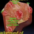 liver-cancer-hcc-vs-metastatic-3d-model-faf630fd32.jpg Liver cancer HCC vs Metastatic 3D model