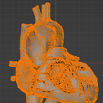 25.png 3D Model of Bicuspid Aortic Valve (BAV)