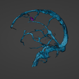 w24.png 3D Model of Brain Arteriovenous Malformation
