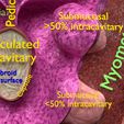 0008.jpg Fibroid Uterus Human female 3D