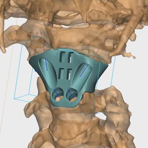 Individual implant (cage) for a patient with a C2 tumor (an example of a real operation) 3D model