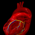 3.png 3D Model of Partial Anomalous Pulmonary Venous Connection