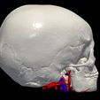 02.jpg 3D Model of Brain Arteriovenous Malformation