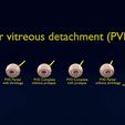 posterior-vitreous-detachment-types-eye-3d-model-blend-87.jpg Posterior vitreous detachment types eye 3D model