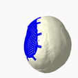 Capture4.png CRANIAL IMPLANT WITH DEFECT