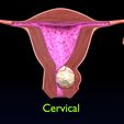 cerv0001.jpg Útero normal frente a tipos de fibromas 3d set