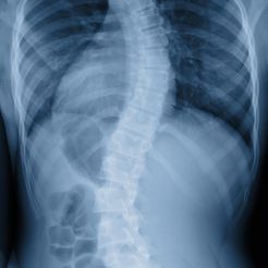 Scoliosis.jpg The Twisted one