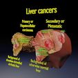 liver-cancer-hcc-vs-metastatic-3d-model-6042c3ae59.jpg Liver cancer HCC vs Metastatic 3D model