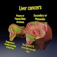 liver-cancer-hcc-vs-metastatic-3d-model-6042c3ae59.jpg Cancer du foie HCC vs métastatique Modèle 3D