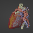 2.png 3D Model of Human Heart with Transposition of Great Arteries (TGA) - generated from real patient