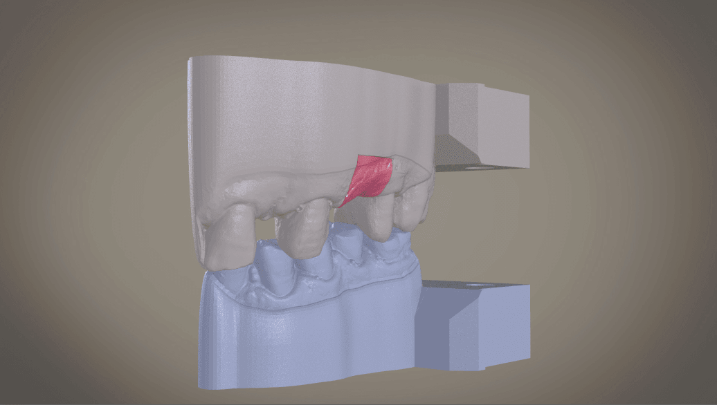 Screenshot_1.png STL file Digital Implant Model with Soft Tissue・3D printer design to download, LabMagic3D