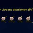 posterior-vitreous-detachment-types-eye-3d-model-blend-75.jpg Posterior vitreous detachment types eye 3D model
