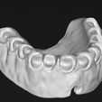 up1.jpg Digital total dentures
