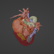 6.png 3D Model of Human Heart with Interrupted Aortic Arch (IAA) - generated from real patient