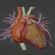 1.png 3D Model of Human Heart with Transposition of Great Arteries (TGA) - generated from real patient
