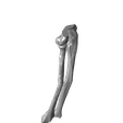 Both_bone_malunion_sag_20_degrees.png Entire collection of simulated forarm angulated malunions