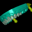 UpperJaw veneer n articulator 2.png STL file Dental Model With 10 Veneers and Articulator・Model to download and 3D print