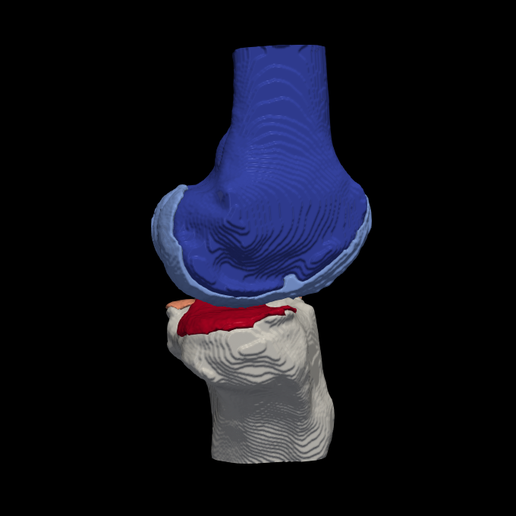 🦵 3D Model of Knee - generated from a real patient・ STL File for ・Cults