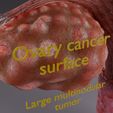 aa-0004.jpg Krukenberg ovarian cancer tumor